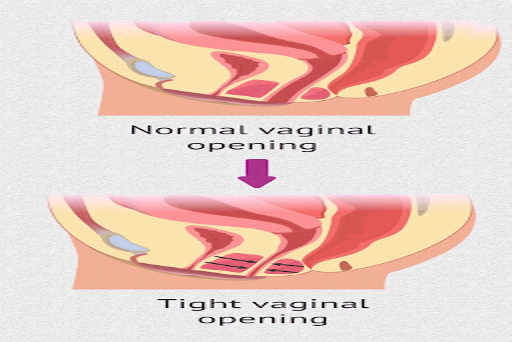 Know about Primary and Secondary Vaginismus 